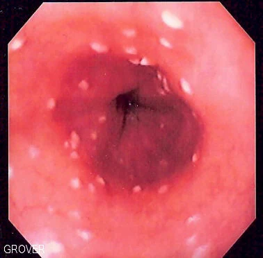 Endoscopic view of esophageal candidiasis in the esophagus
