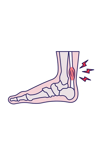 Illustration of a sprain