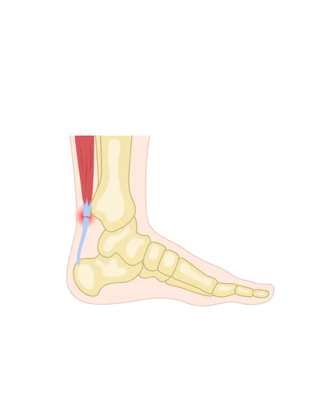 Illustration of a strain
