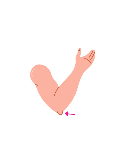 Illustration of tendinitis at the elbow (tennis elbow)