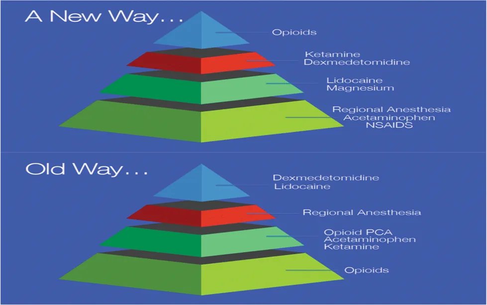 New paradigm in analgesia management
