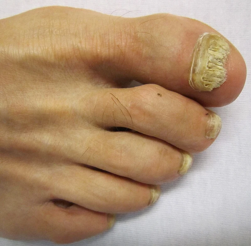 Toenails thickened and discolored by onychomycosis, a candidiasis of the nail