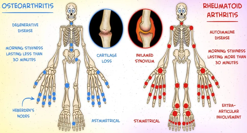 Osteoarthritis
