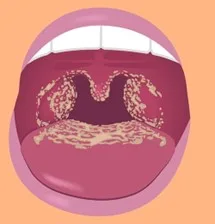 Understanding oral thrush